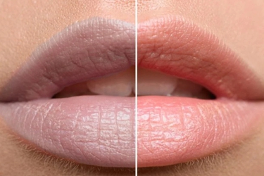Dark Lip Correction in Mohali, Smoker's Lip Treatment in Punjab, Best Centre for Dark Lip Correction in Mohali, Punjab, India, Cost of Dark Lip Correction in Mohali