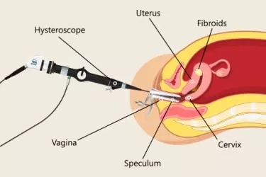 Day Care Hysteroscopy in Mohali, hysteroscopy in Punjab, uterine fibroid removal by hysteroscopy, best gynae clinic for hysteroscopy in Punjab, Cost of Hysteroscopy in Mohali, Punjab