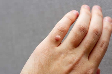 Laser Wart Removal, Laser Mole Removal, Best Centre for Wart and Mole Removal in Mohali, Cost of Laser Wart Removal, CLAGS Best Cosmetic and Laser Centre in Mohali, Punjab